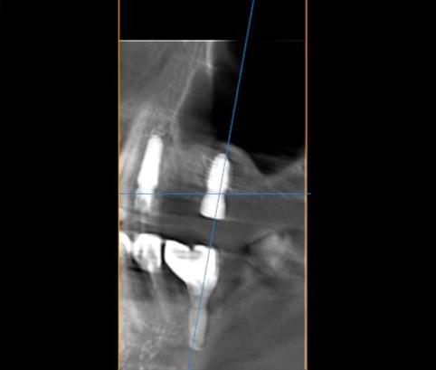 Имплантация при остаточной кости 2 мм без открытого синус-лифтинга
